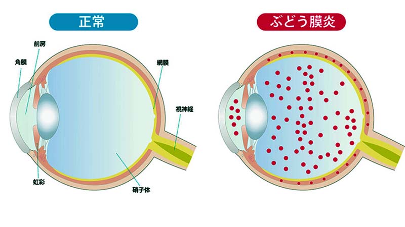 ぶどう膜炎