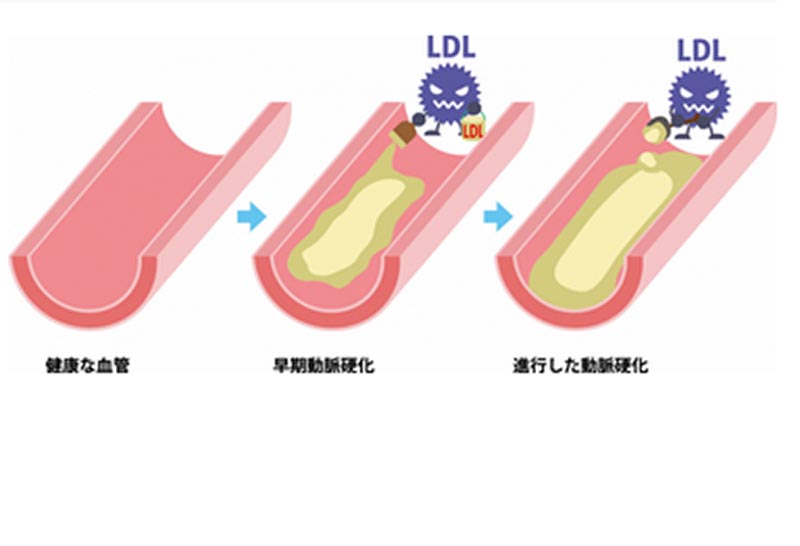 高コレステロール血症
