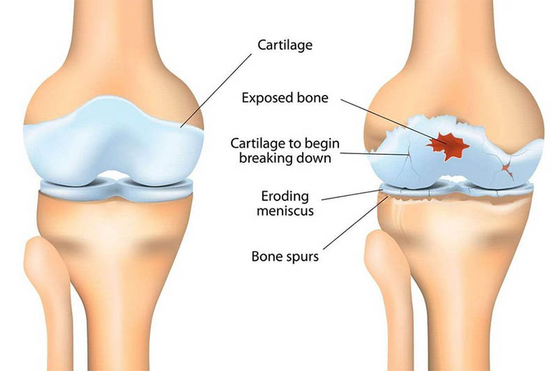 関節の再生治療が可能に